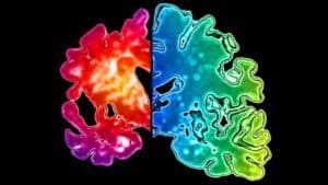 What the brain looks like with a normal brain on one side and on the other side a brain affected with Alzheimers